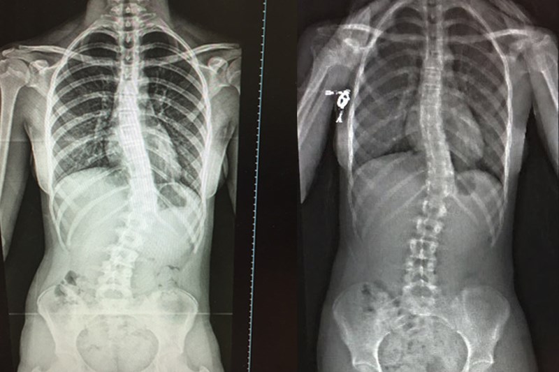 left: before bracing, right: after 6 weeks in the Cheneau-Gensingen brace