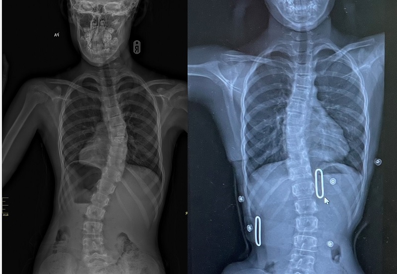 Above: Beau’s latest in-brace X-ray (right) shows the marked improvement to her spine compared to her last X-ray in July 2020 (left).