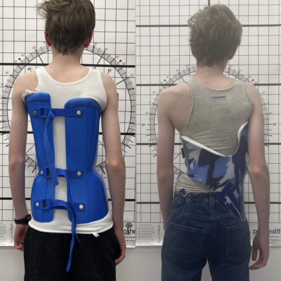Left: Adolescent male patient wearing a traditional Boston brace. Right: a bespoke LOC Scoliosis Brace on the same patient.