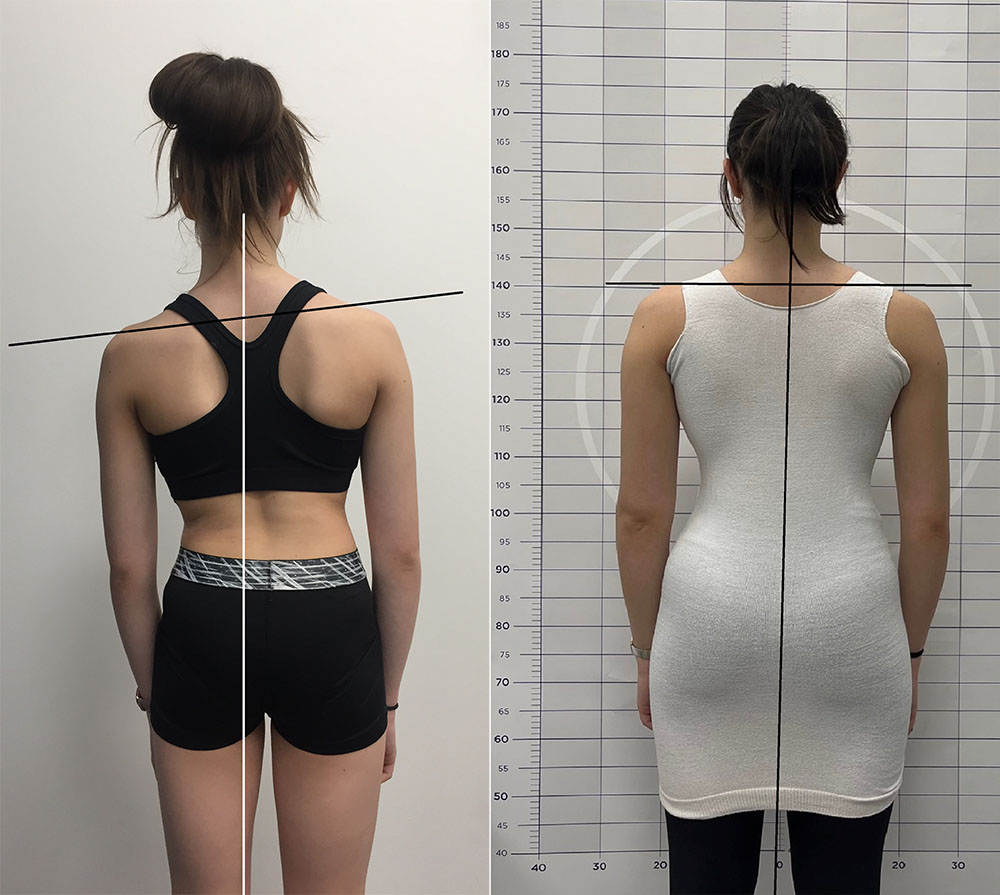 Adolescent idiopathic scoliosis patient before and after bracing.