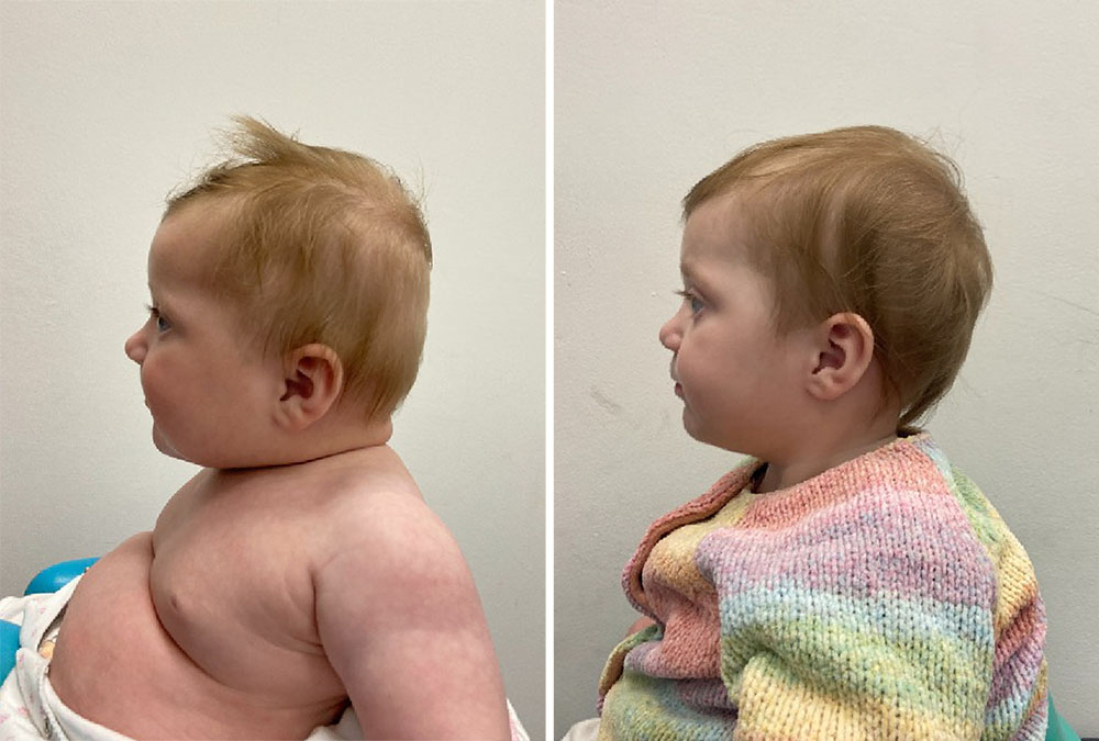 Before and after six months cranial remoulding therapy with the LOCband Lite helmet.