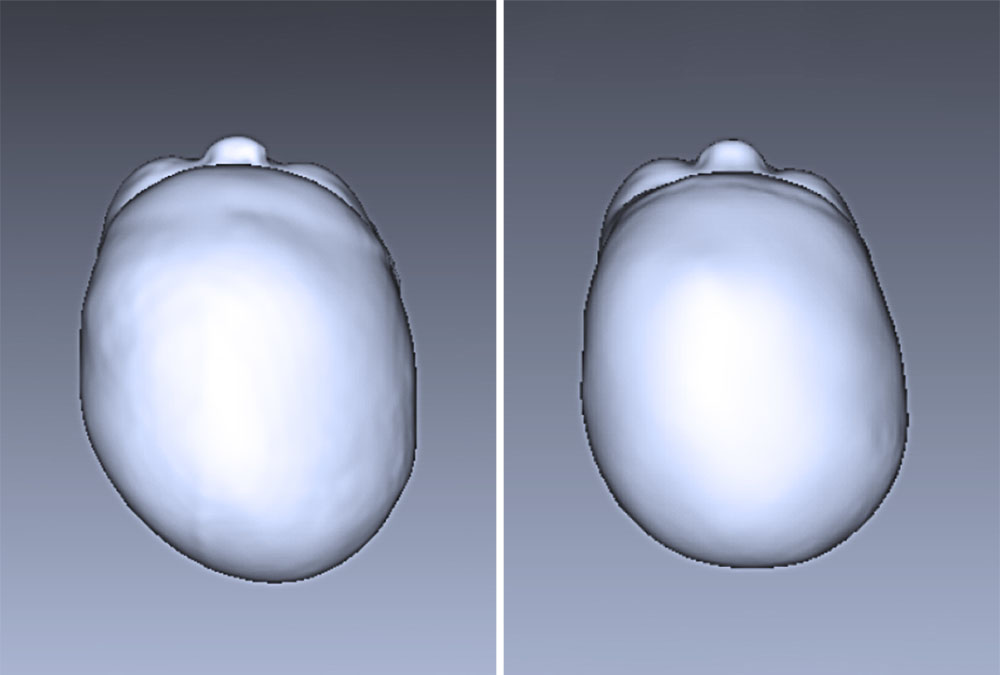 Amelia's head scan before treatment with an asymmetry value of 18mm, and after, at 9mm.