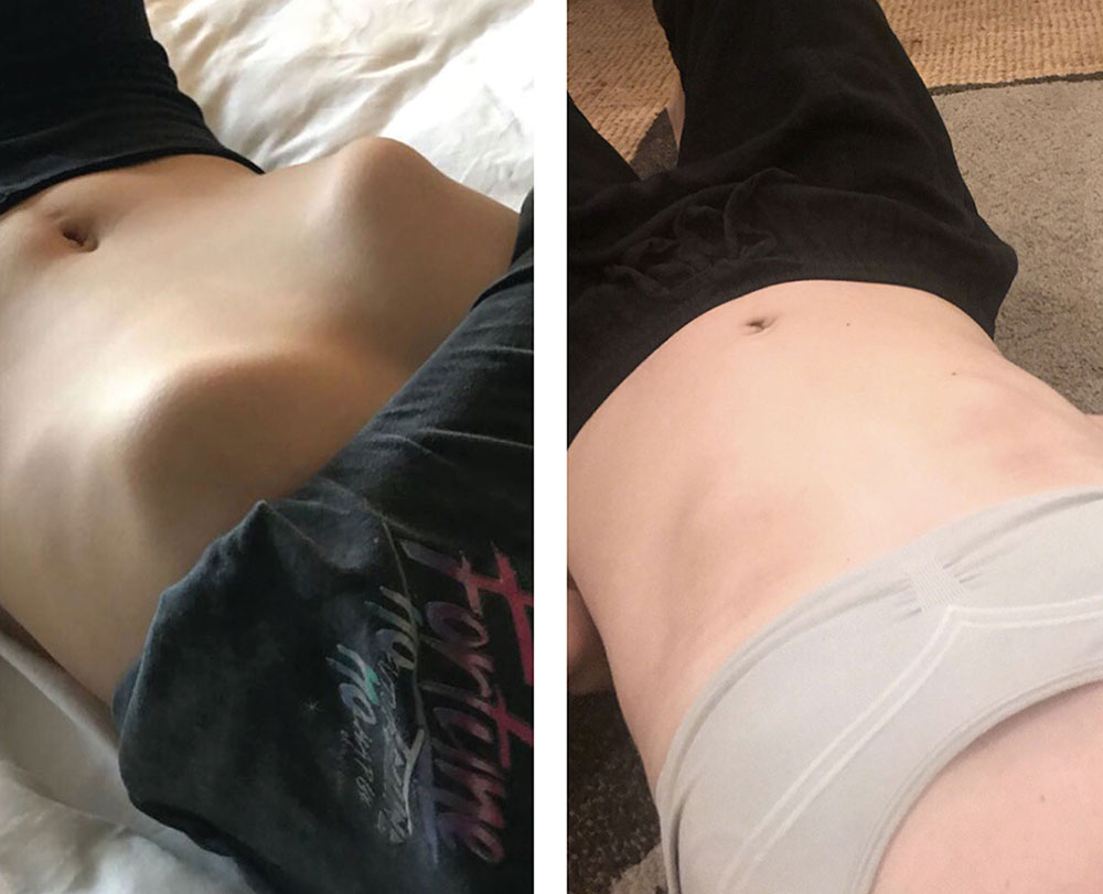 Patient with rib flaring before and after treatment