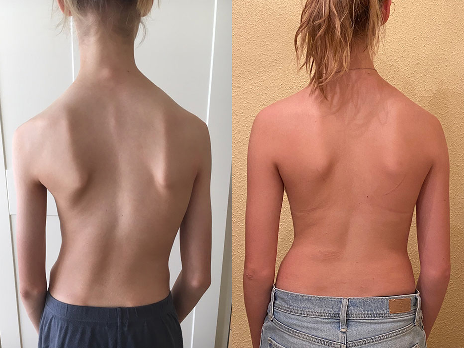 'S-curve' in an adolescent idiopathic scoliosis patient before and after bracing treatment