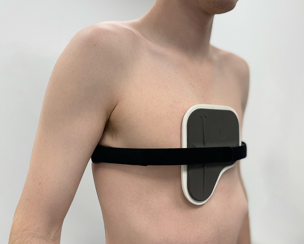 Pectus carinatum patient wearing a dynamic chest compressor brace from the London Orthotic Consultancy