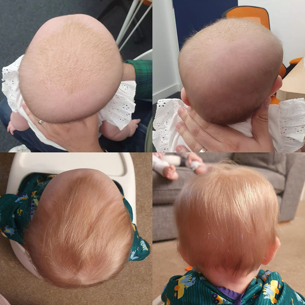 Head shots from before and after plagiocephaly helmet therapy treatment
