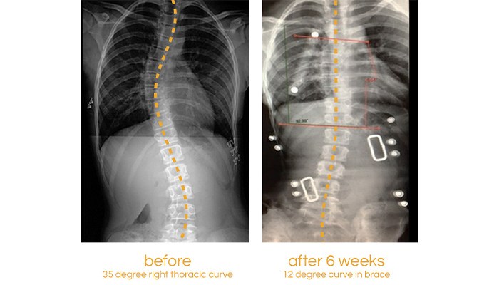 Adolescent Scoliosis