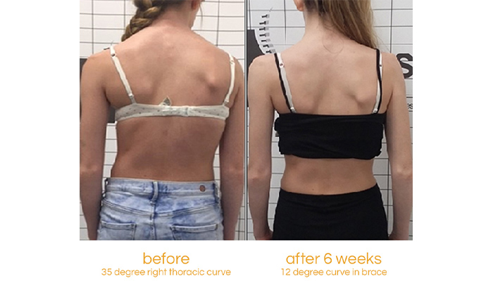 My Journey with an S Curve and Adolescent Idiopathic Scoliosis
