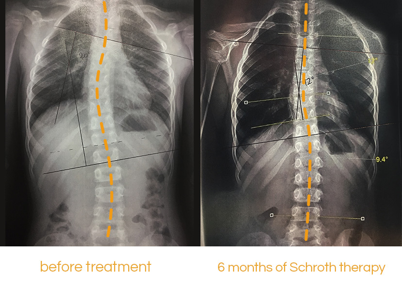 Juvenile Scoliosis Story