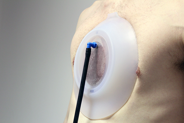 Vacuum Bell therapy on chest