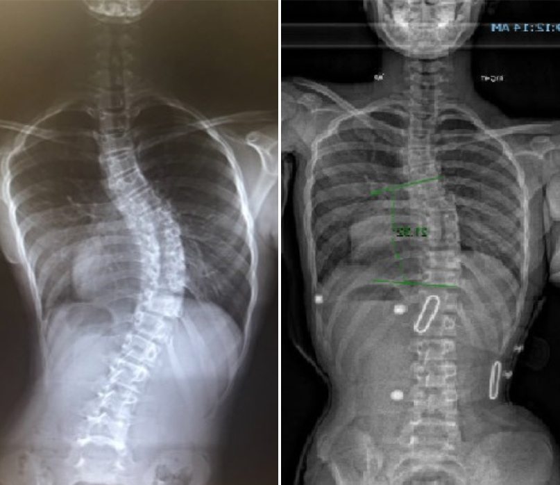 4 Tips for Wearing a Scoliosis Brace More Comfortably