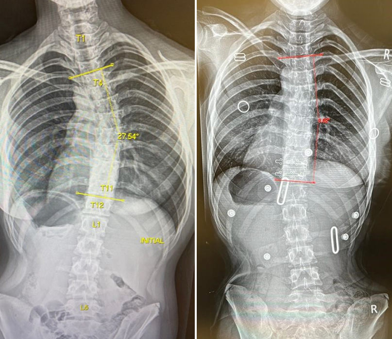 Scoliosis Braces: Can Scoliosis be Corrected with a Brace? - Turan&Turan