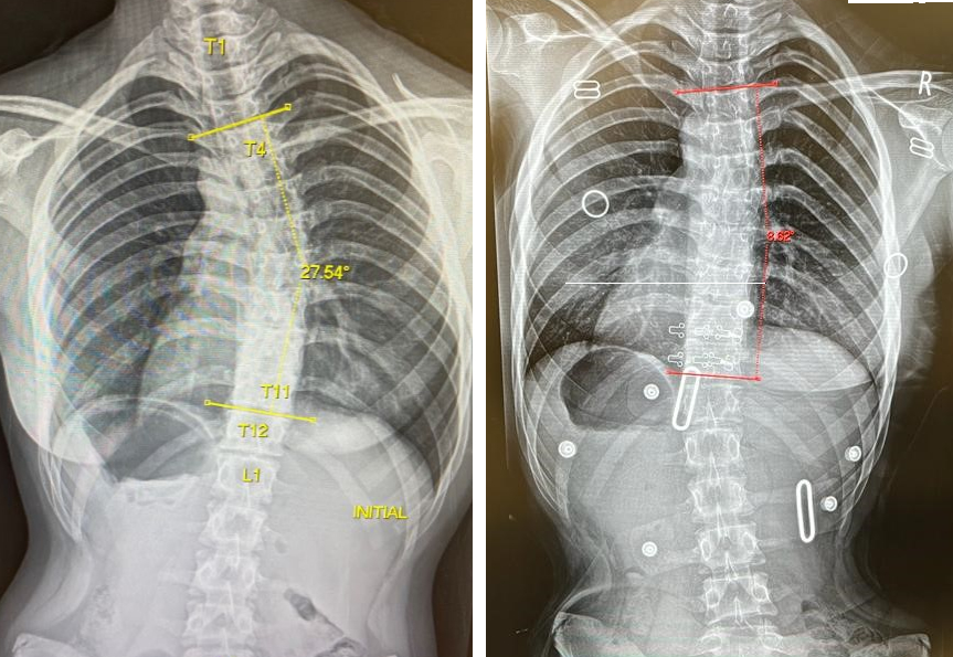 Scoliosis in Teens: What a Back Brace Can and Can't Accomplish