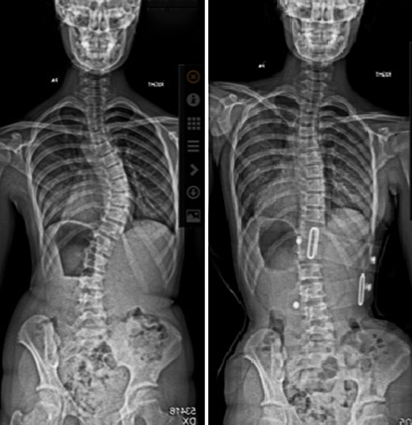 hospital brace Archives - Scoliosis Clinic UK - Treating Scoliosis without  surgery