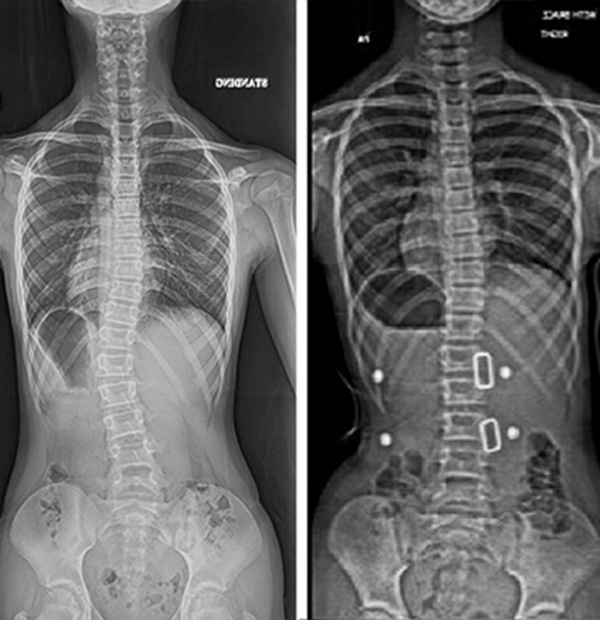 A brace to address functional 4-curve patterns for right thoracic
