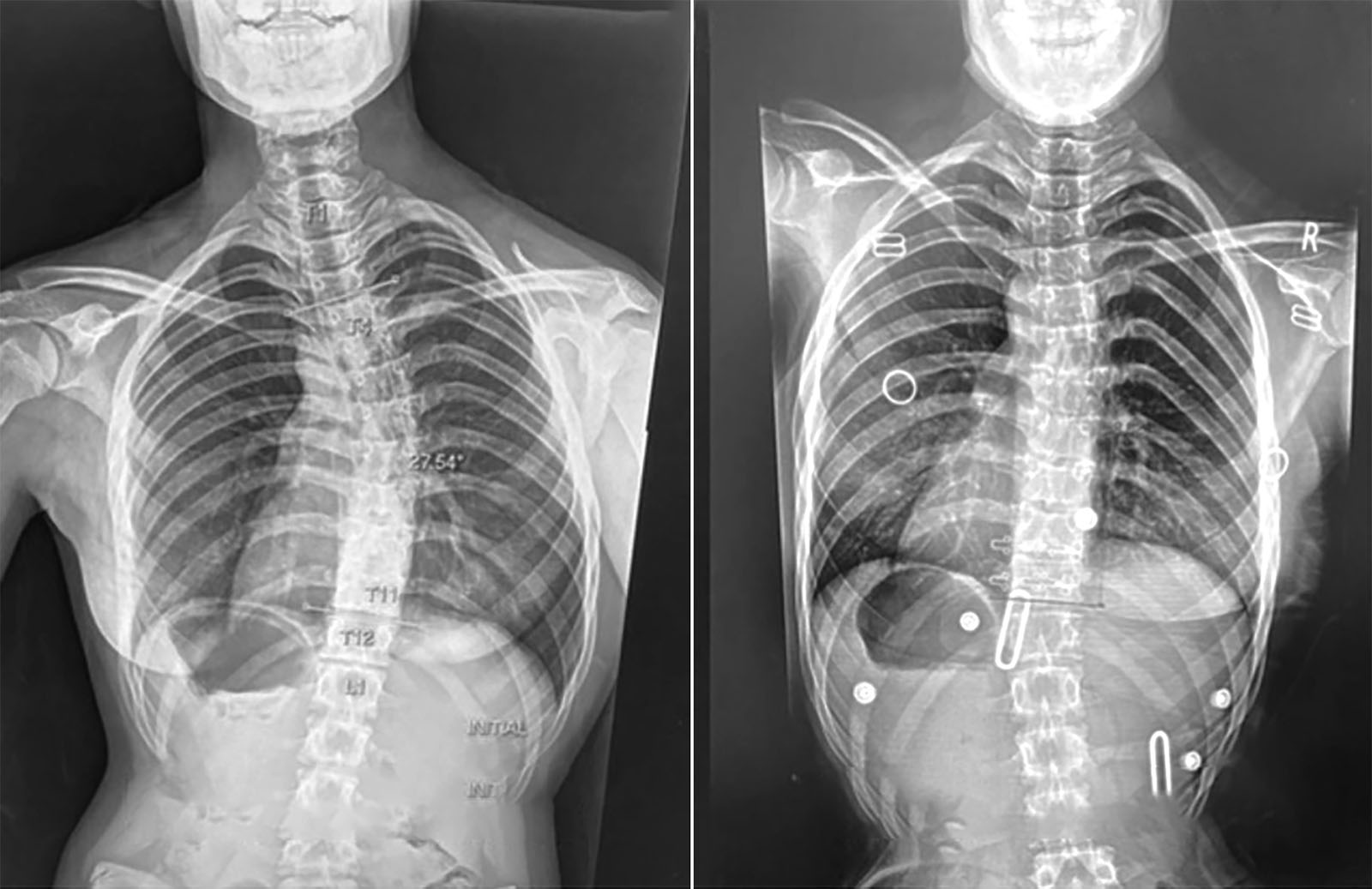 Adolescent Idiopathic Scoliosis patient before after bracing treatment
