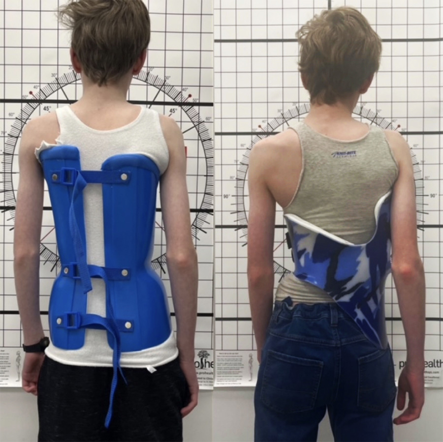 Adolescent male patient wearing a traditional Boston brace. Right: a bespoke LOC Scoliosis Brace on the same patient.