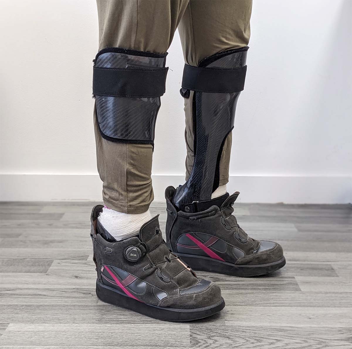 Bilateral club foot patient wearing bespoke carbon-fibre orthoses and shoes