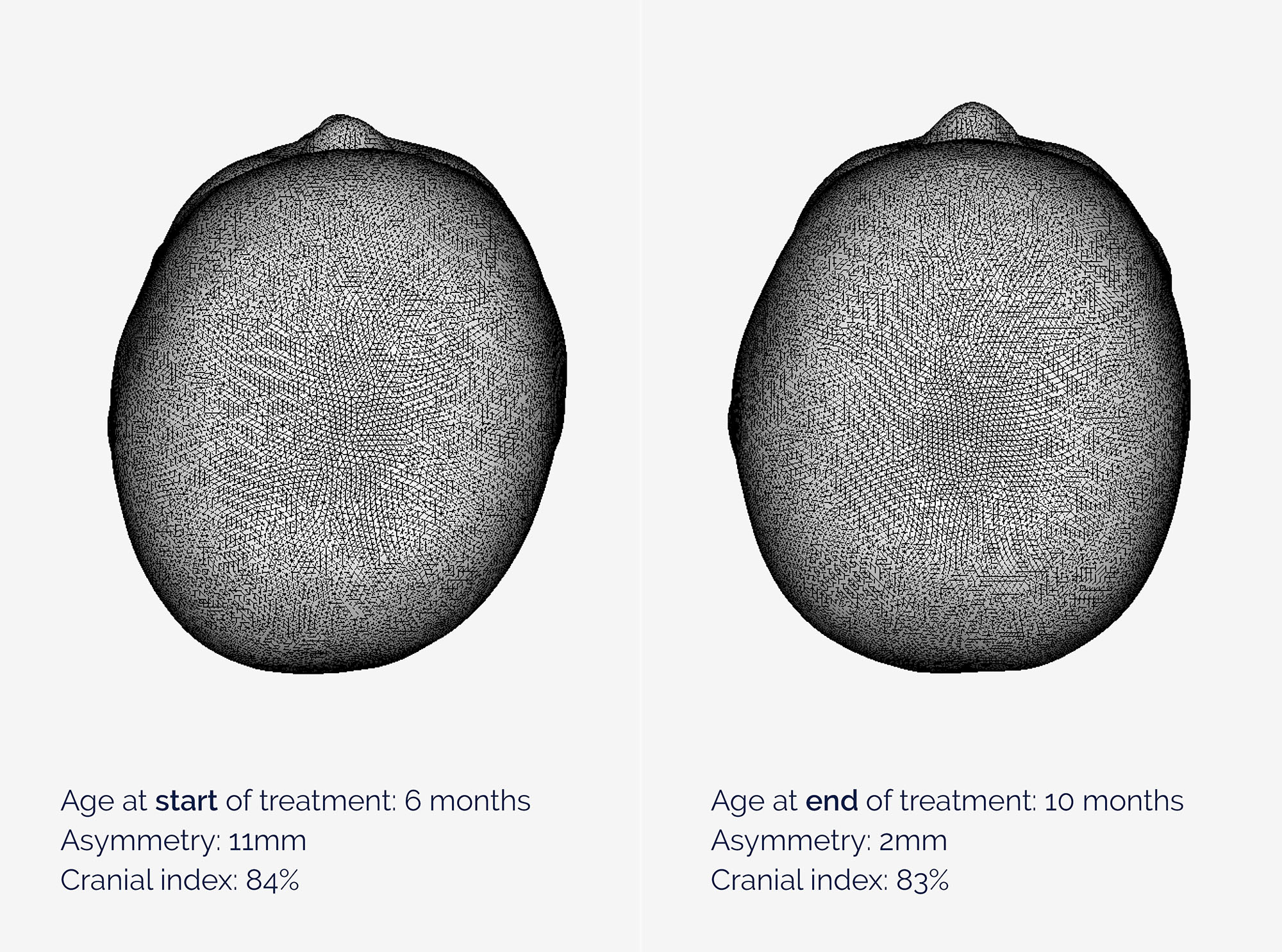 Plagiocephaly head scans show asymmetry value of 11mm before cranial remoulding therapy, and after with a value of 2mm