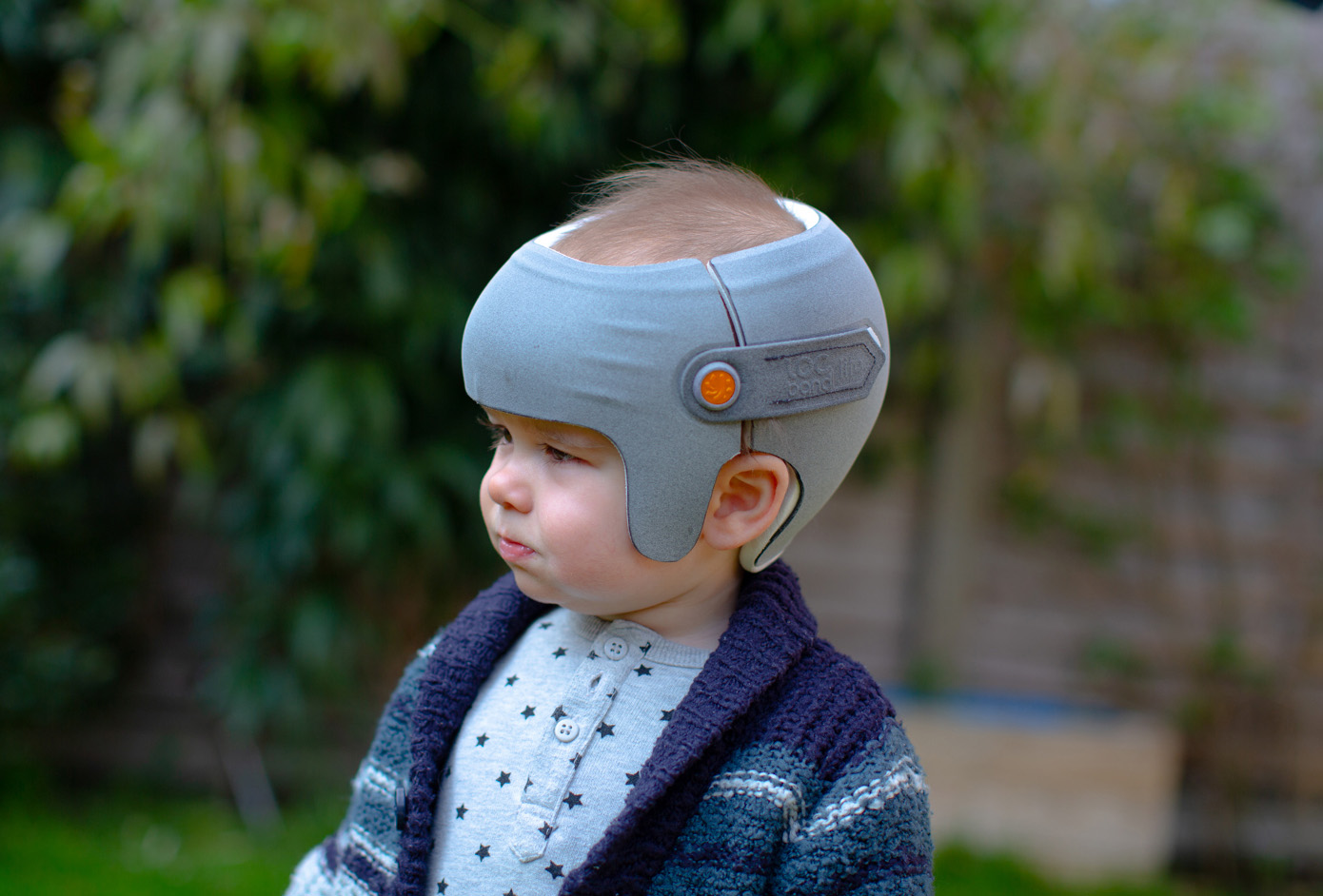 The LOCBand Lite helmet from the London Orthotic Consultancy