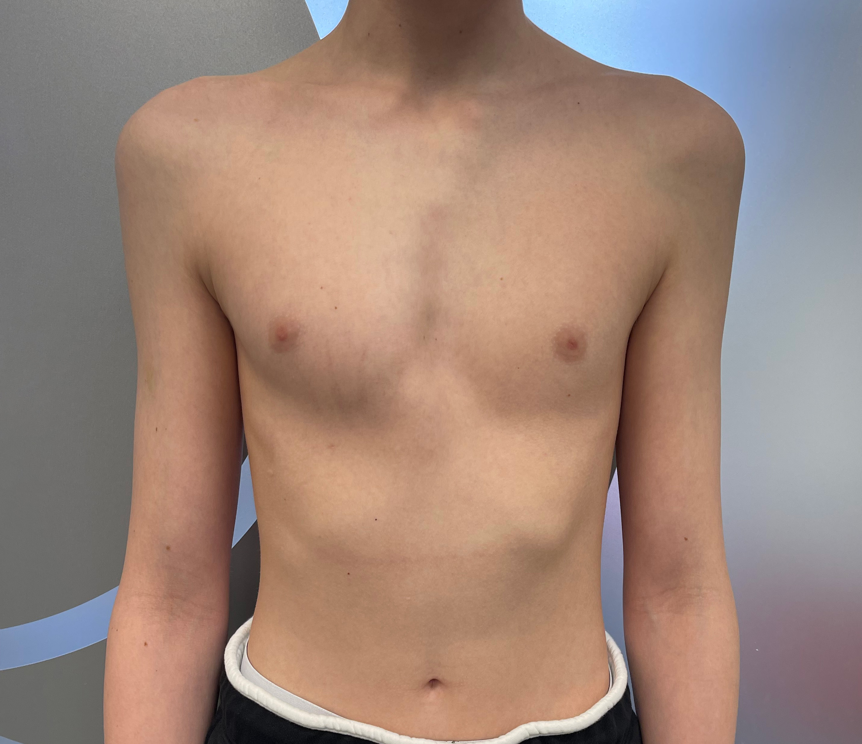 Complex chest deformity with pectus carinatum and pectus excavatum as well as rib flaring