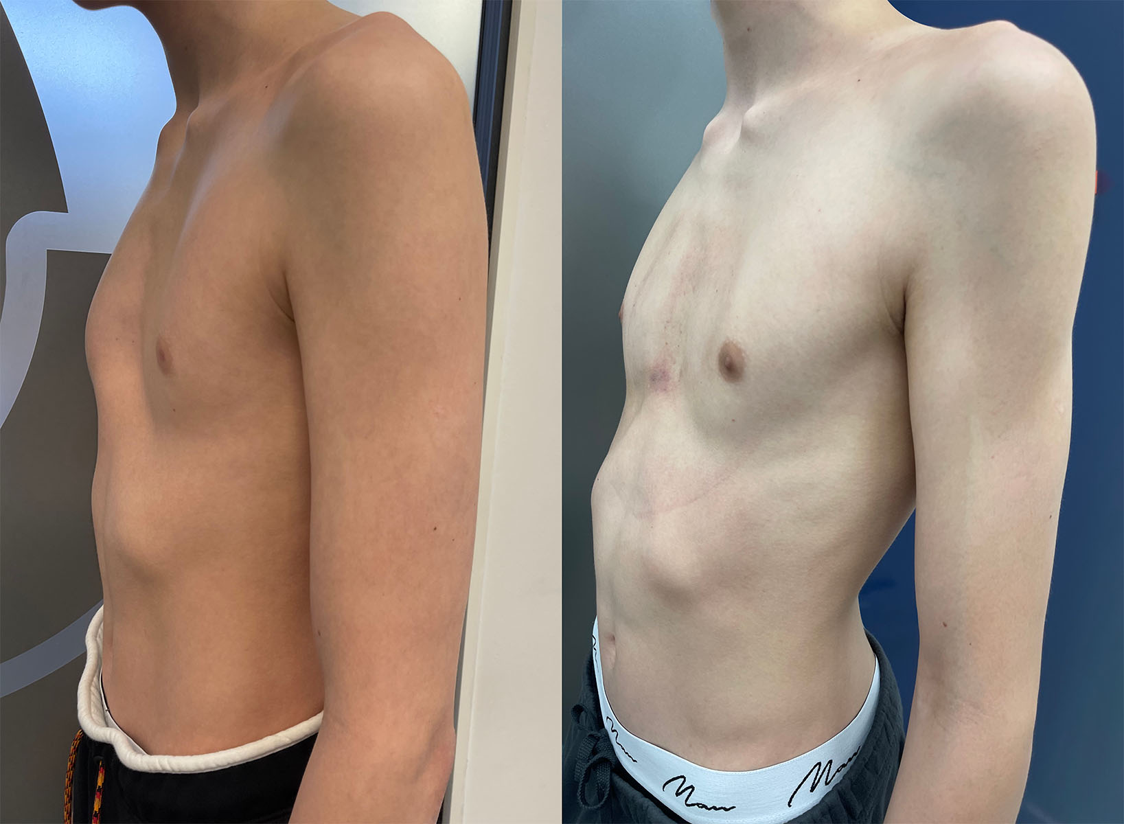 Before and during pectus bracing treatment