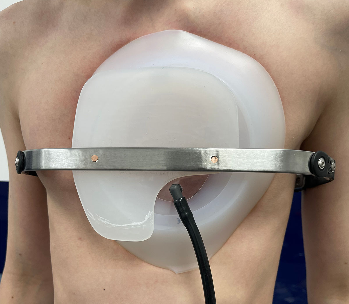 Patient wearing the vacuum bell to address pectus excavatum deformity