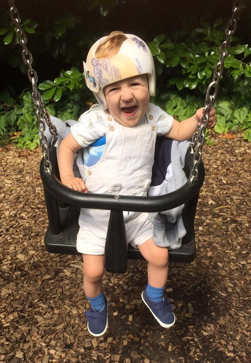 Child wearing LOCband helmet during cranial remoulding therapy