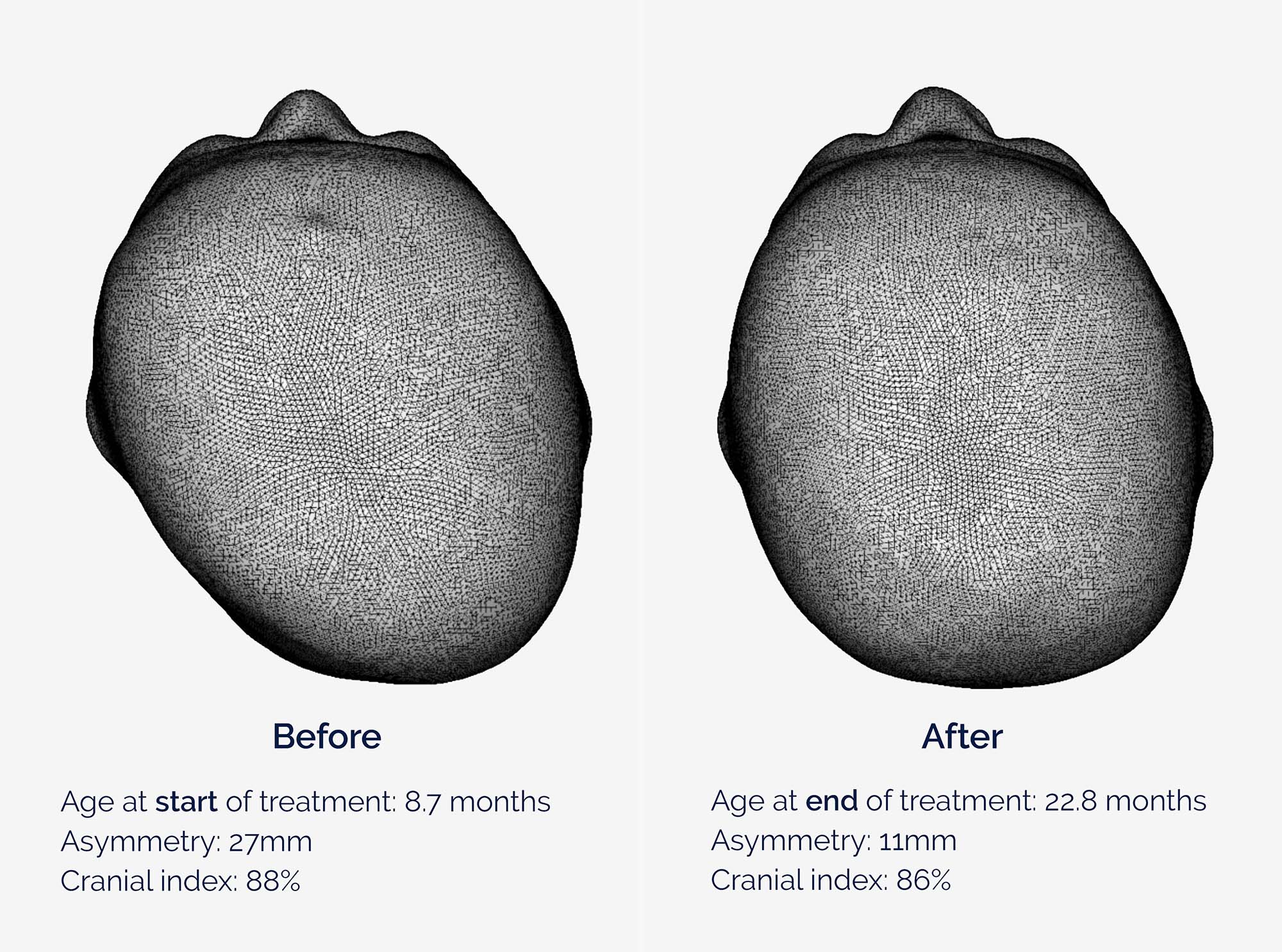 Freddie's head scans show an asymmetry value of 27mm before cranial remoulding therapy, and after with a value of 11mm