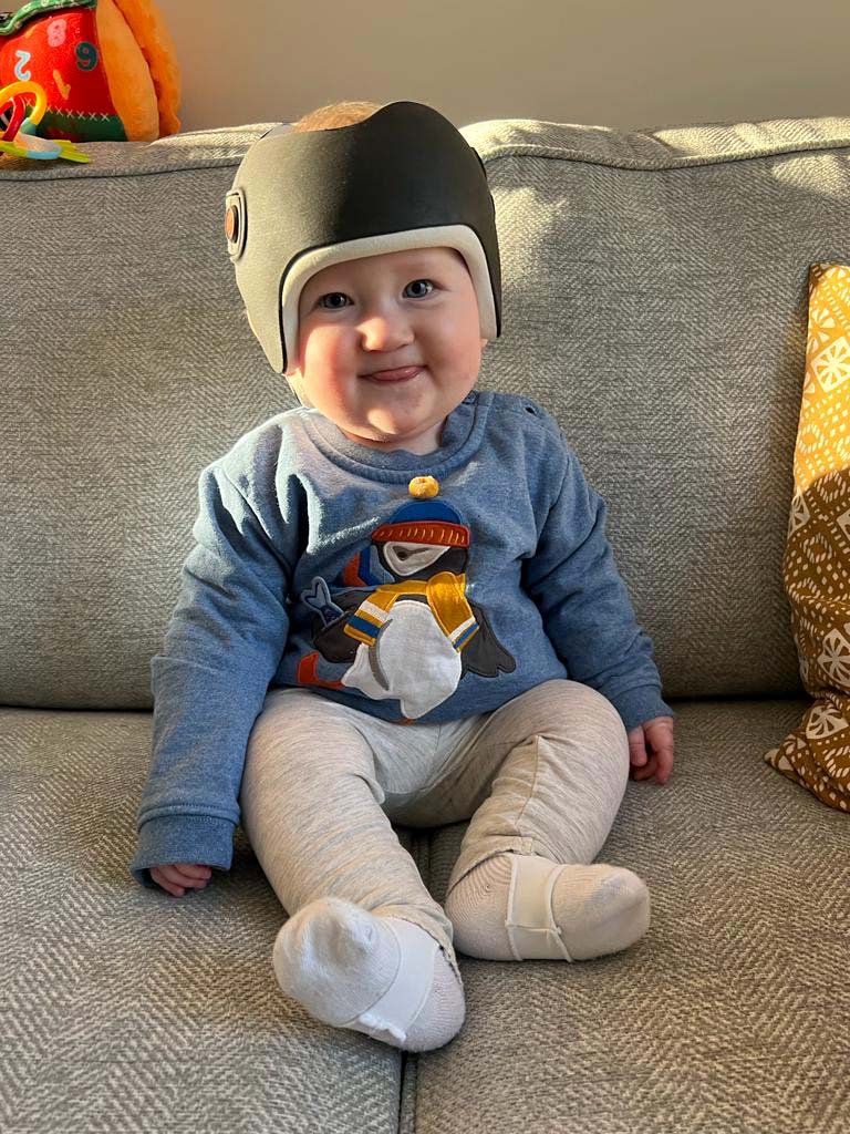 Amelia wearing the LOCband Lite cranial moulding helmet during helmet therapy