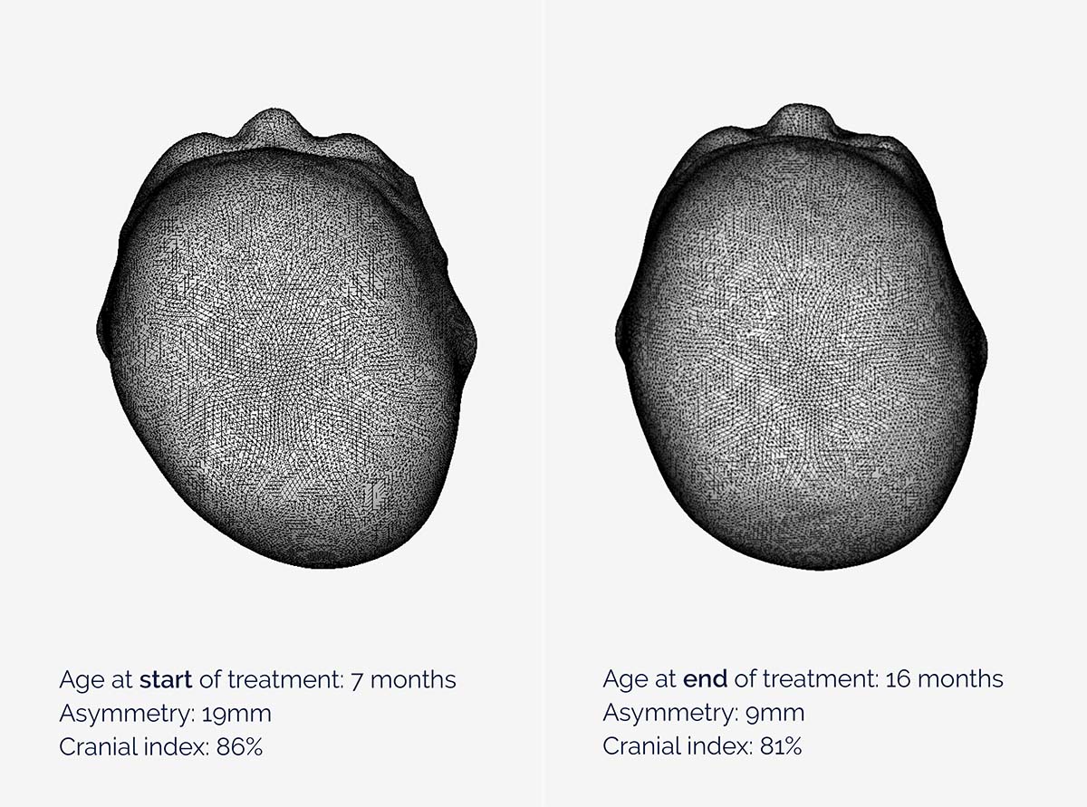 Amelia's head scans show an asymmetry value of 19mm before cranial remoulding therapy, and after with a value of 9mm