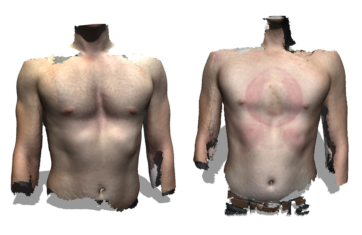 Before and during vacuum bell therapy treatment with the rib flaring brace