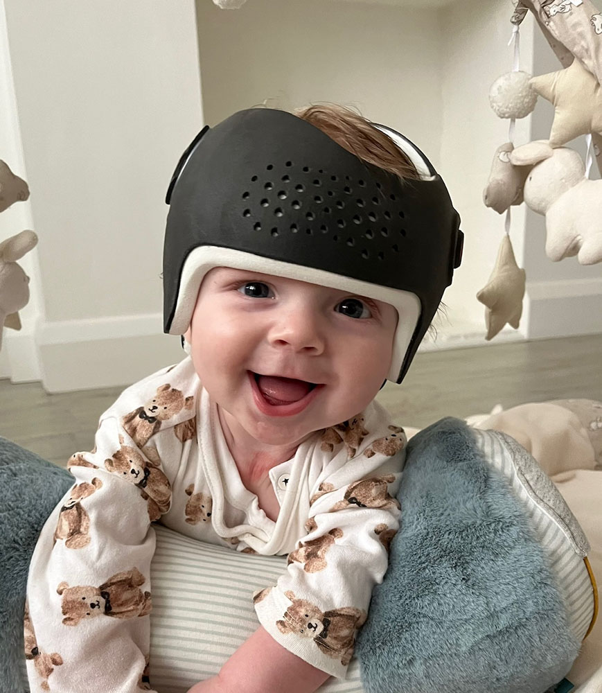 Baby boy who was diagnosed with brachycephaly successfully treated with the LOCband Lite.