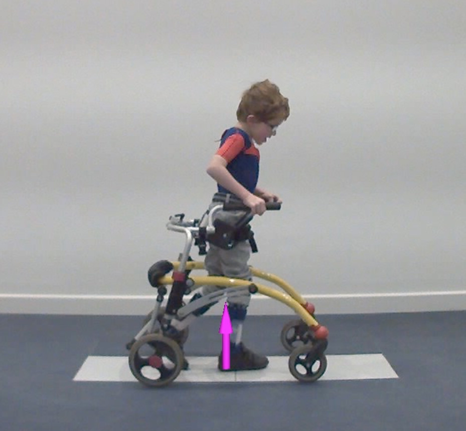 Gait lab cerebral palsy patient