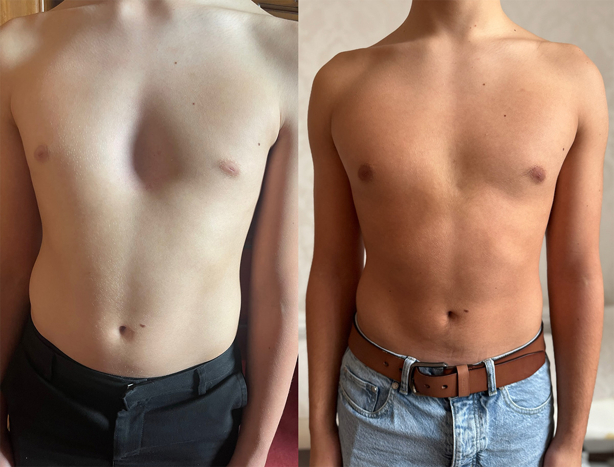 Chest of a pectus excavatum patient before and after vacuum bell therapy front view