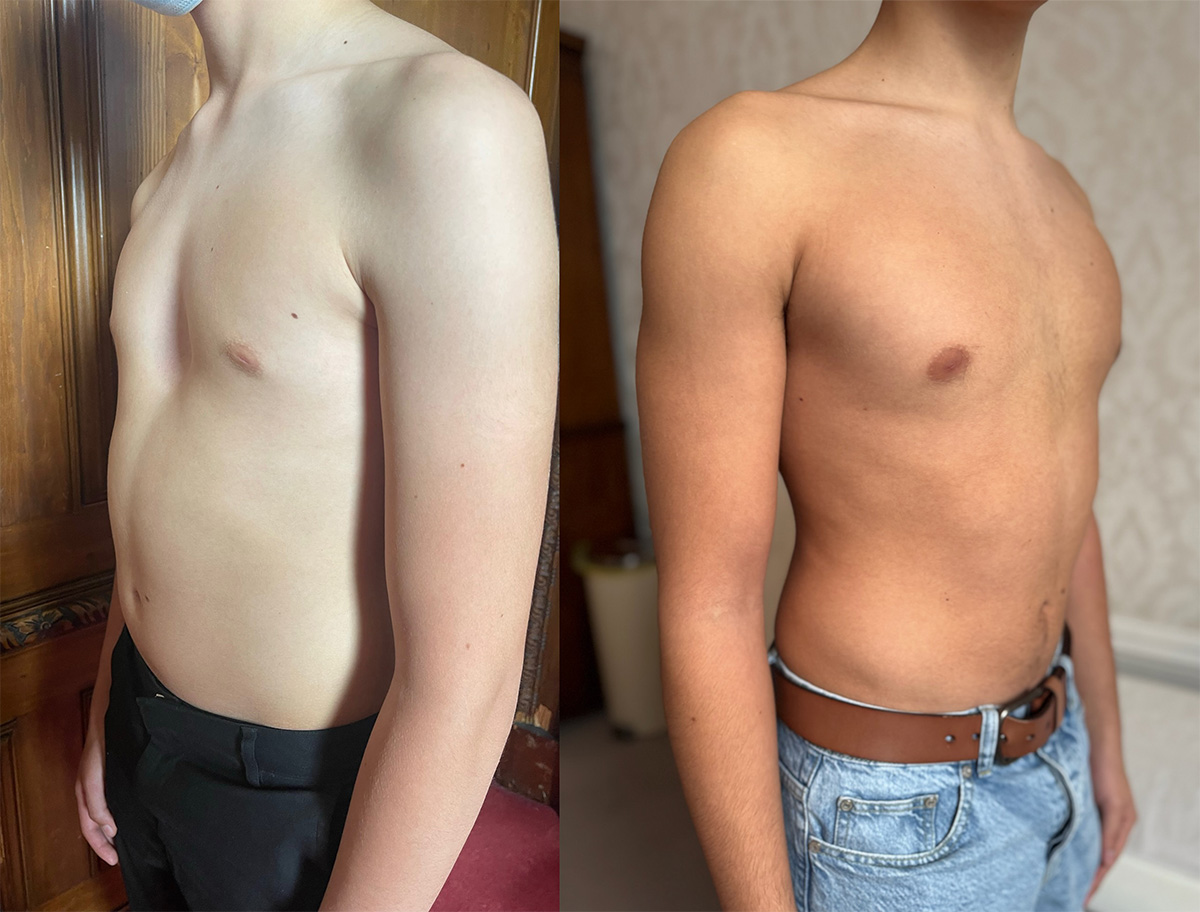 Chest of a pectus excavatum patient before and after vacuum bell therapy view from the side