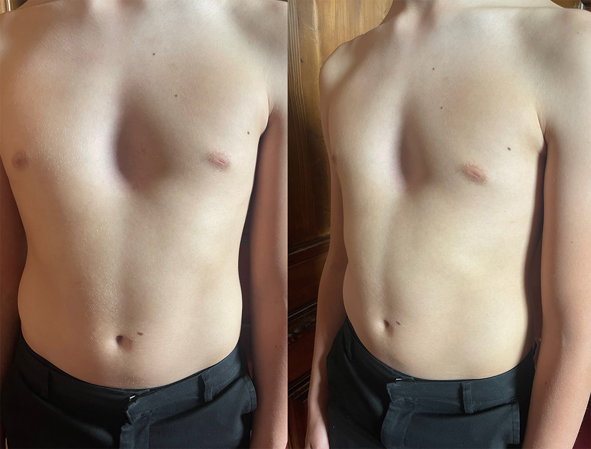 Chest appearance of pectus excavatum