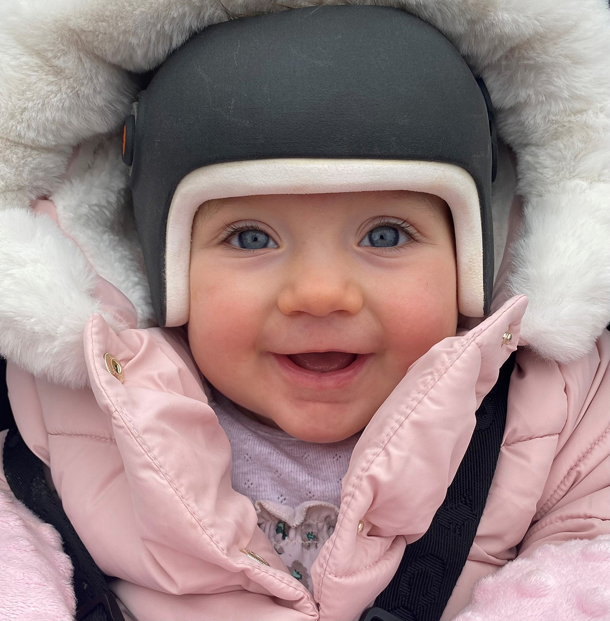 Baby in her LOCband Lite plagiocephaly helmet from the London Orthotic Consultancy