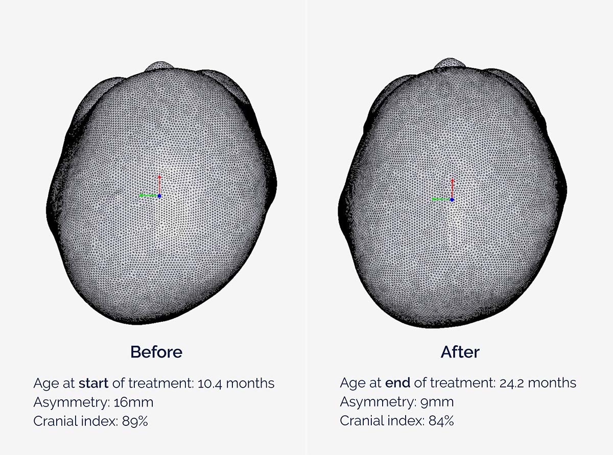 Max's results before and after helmet therapy